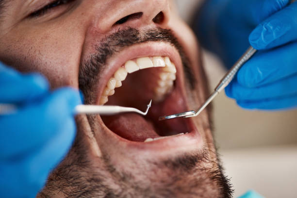Best Emergency Wisdom Teeth Removal in Princeton, NJ